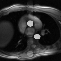 Vascular ghosting artifact